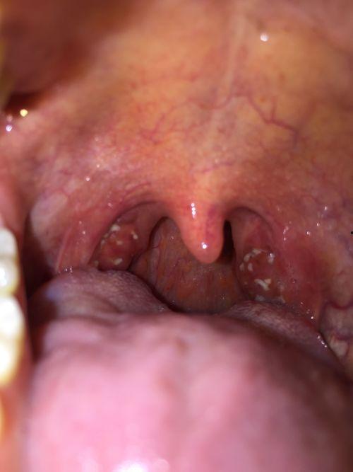 夏天吃瓜喉咙沙哑了,如何缓解喉咙不适？